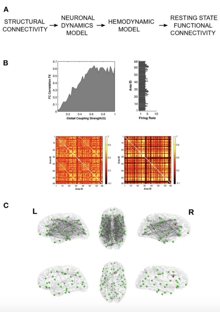 Whole-brain model of a focal lesion (right anterior cingulate): simulated and empirical functional-connectivity maps are matched, then the model shows how local plasticity restores lost links as excitation–inhibition balance returns. 